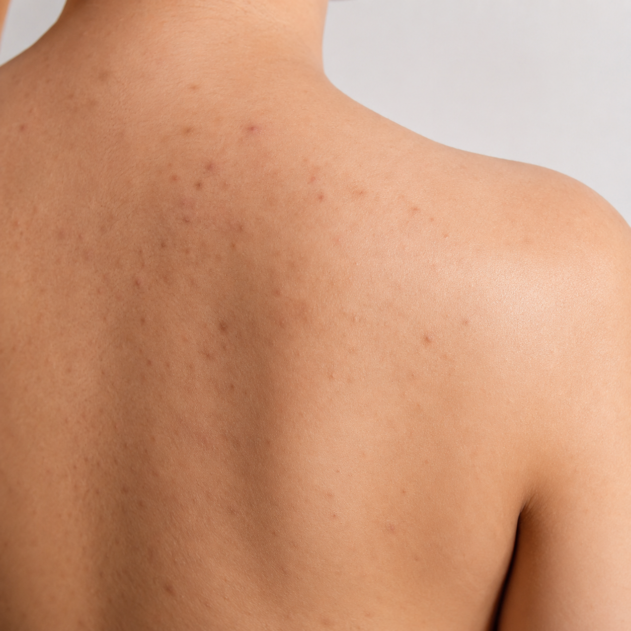 Close-up of visible marks on upper back skin
