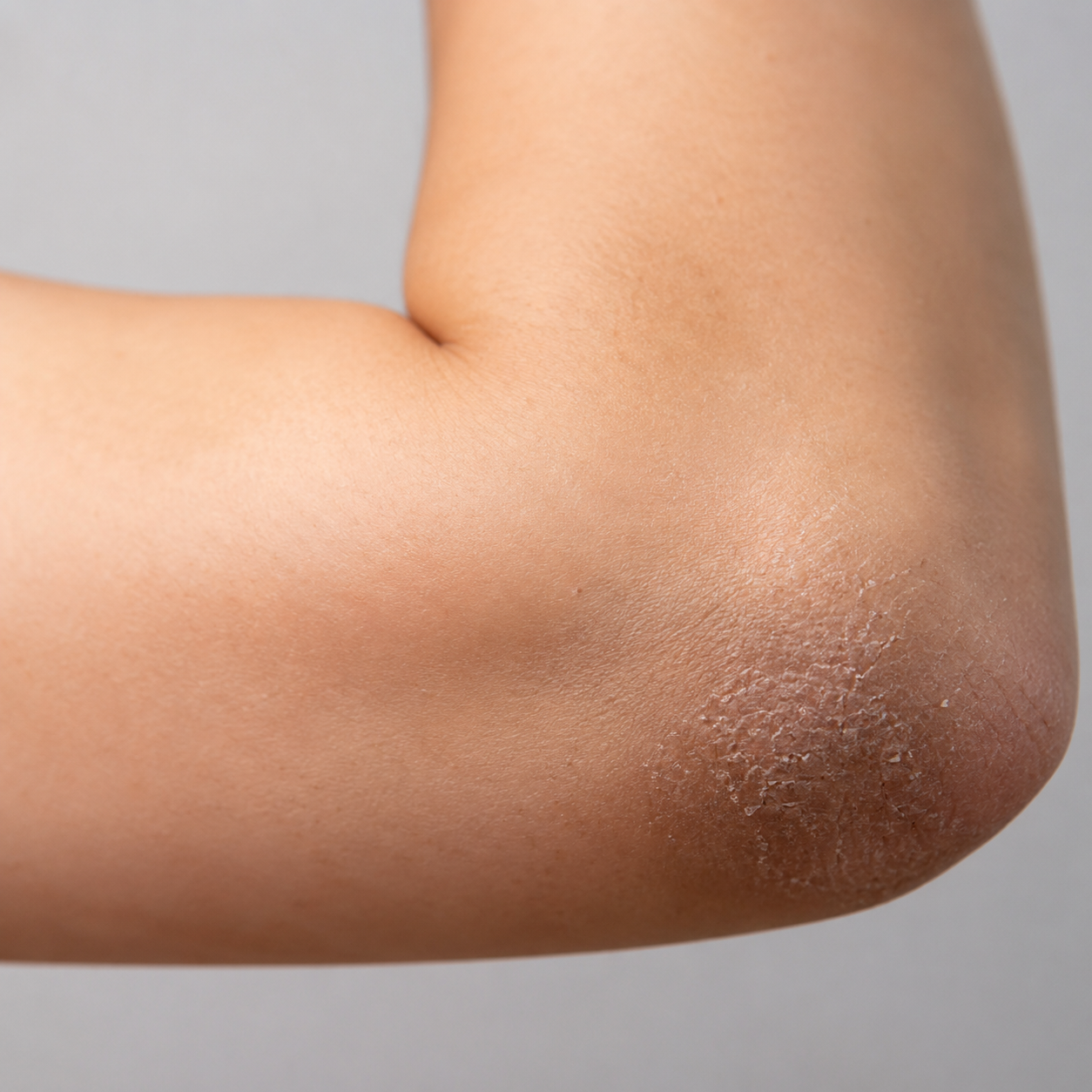 Close-up of dry and rough-looking elbow skin